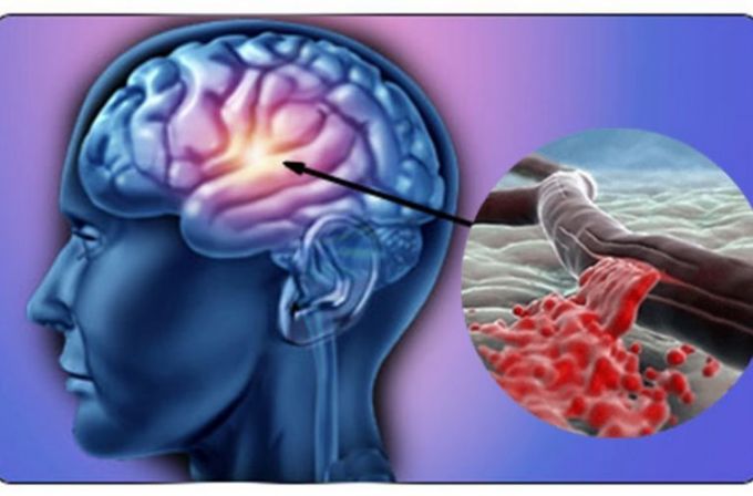Care este tratamentul și procesul de recuperare după accidentul vascular cerebral?