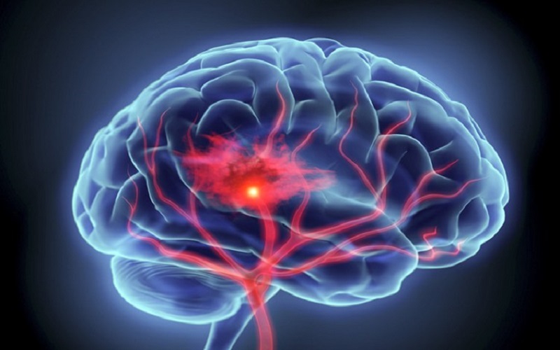 Prevenirea accidentului vascular cerebral